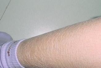 鱼鳞病和皮肤干燥有关系吗?