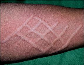 人工性荨麻疹有什么症状和特点?