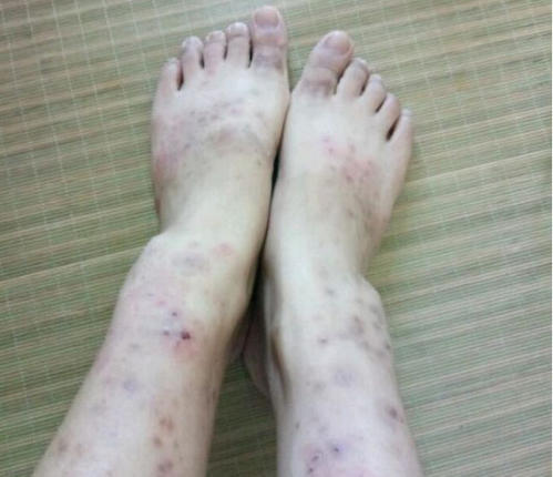 湿疹都有哪些类型和特点呢?