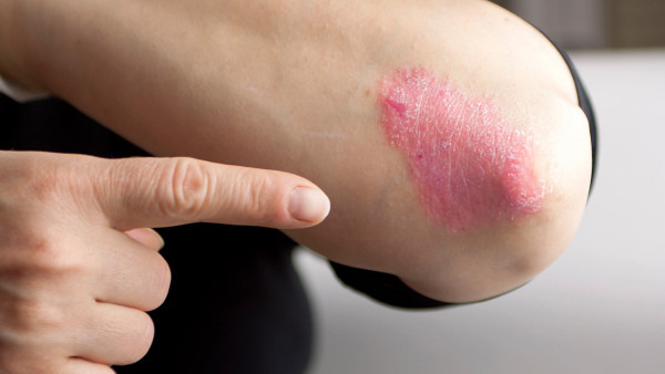 银屑病白屑越来越多是怎么回事?