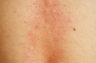 荨麻疹会引起患者出现发烧吗?