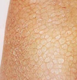 鱼鳞病会引起皮肤瘙痒吗?