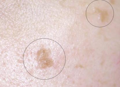 寻常疣和扁平疣有什么区别不同?