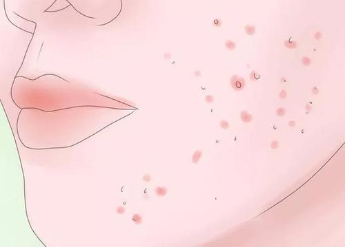 寻常疣会不会越来越多呢?