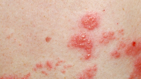 腰上带状疱疹应当注意什么事项呢?