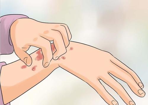 荨麻疹是不是湿热引起的呢?