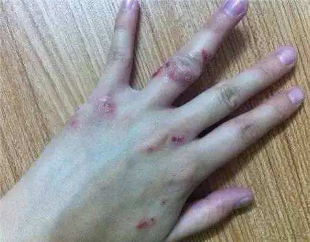 皮肤过敏患者发病期间可以洗澡吗?