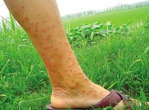 皮肤过敏会和体质有关吗?