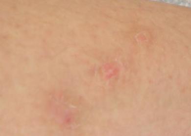 体癣患者应当注意什么事项呢?