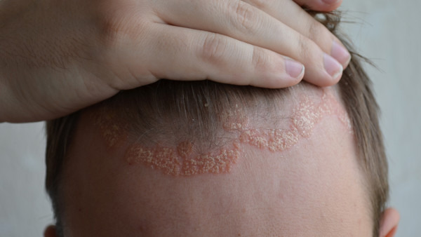 银屑病和脂溢性皮炎要如何区分呢?