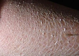 鱼鳞病症状损害会越来越严重吗?