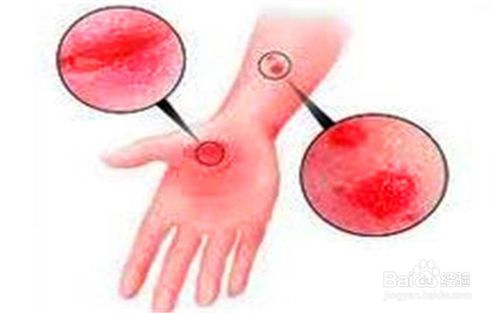 湿疹症状损害会蔓延到全身吗?