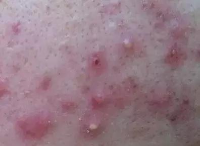 青春痘是不是只在青春期发病?