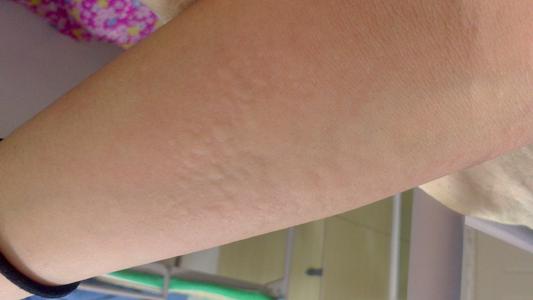 荨麻疹是不是和肝功能有关系呢?