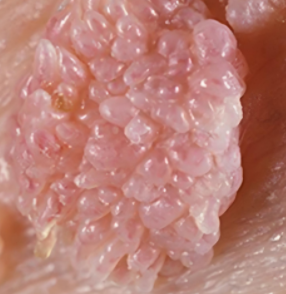 抽血化验能不能检查出来湿疣呢?