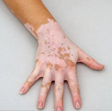 散发性白癜风有什么特点呢?