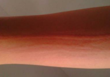 荨麻疹患者平时洗澡要注意哪些事项?