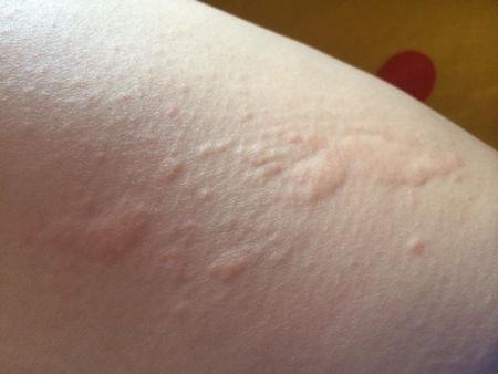 荨麻疹患者应当如何护理皮肤好呢?