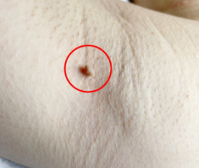 丝状疣一般好发于什么部位呢?