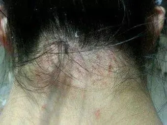 脂溢性皮炎会引起斑秃吗?