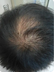 斑秃是不是因为肾虚引起的呢?