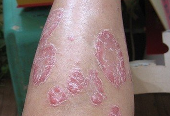 银屑病患者可以喝酒吗?