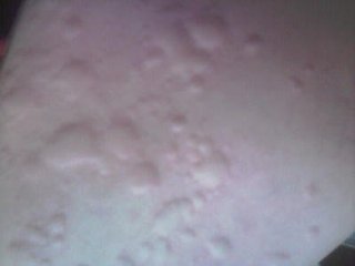 荨麻疹症状上都有哪几种类型呢?