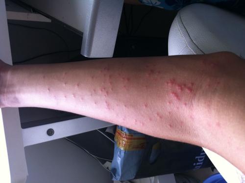 慢性荨麻疹和急性荨麻疹有什么区别?