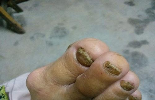 灰指甲是不是需要磨掉坏指甲?