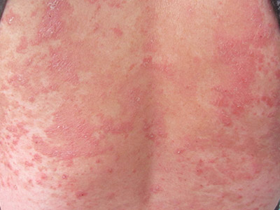 牛皮癣会有水泡损害和症状吗?