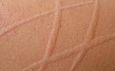 荨麻疹会引起皮肤紧绷吗?