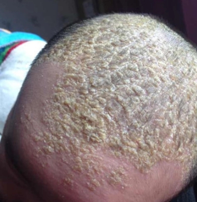 脂溢性皮炎会引起全身皮肤瘙痒吗?