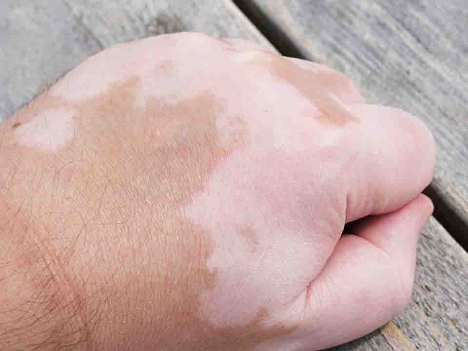 白癜风长期存在可能有哪些并发症?