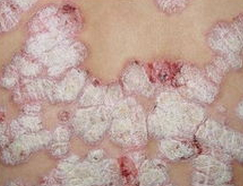 银屑病进行期有哪些特征和表现?