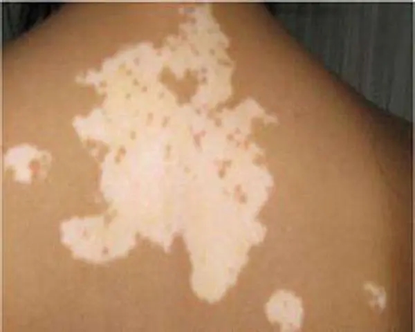 白癜风是不是和外伤有关系呢?