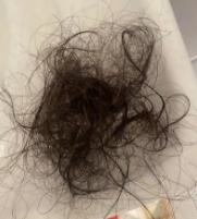 临床上真假斑秃有什么区别?