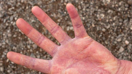 手癣和汗疱疹是怎么鉴别诊断?