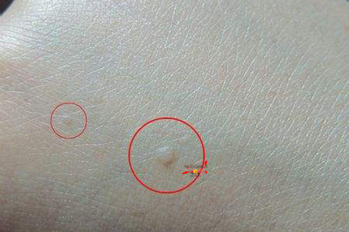 寻常疣的好发部位是哪里呢?