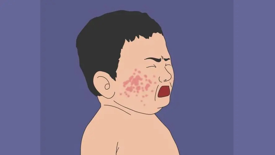 儿童过敏性皮炎都是什么原因导致的?