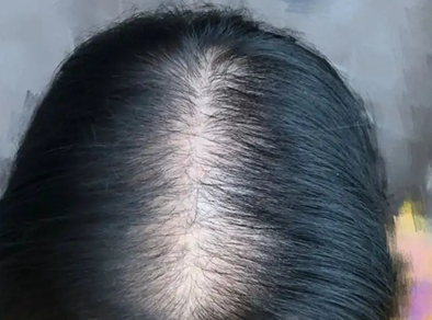病理性脱发和生理性脱发如何区别?