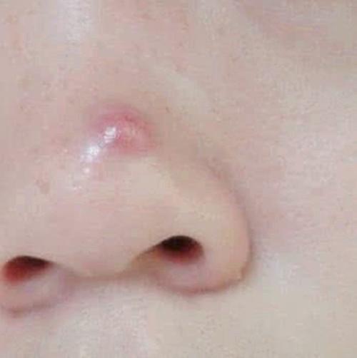 青春痘除了粉刺外还有哪些表现呢?
