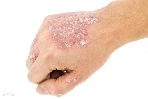 夏季出汗多会加重牛皮癣病情吗?
