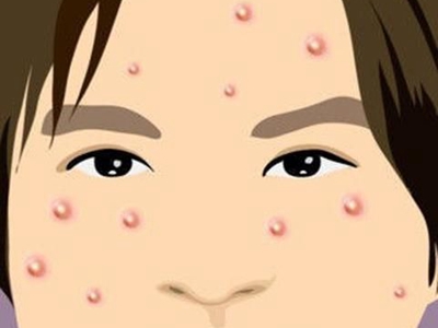 青春痘是因为感染螨虫引起的吗?