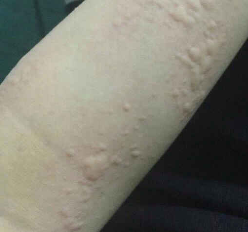 荨麻疹是因为过敏的原因吗?