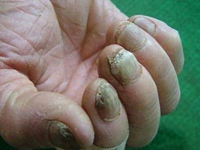 灰指甲颜色变化是加重了吗?