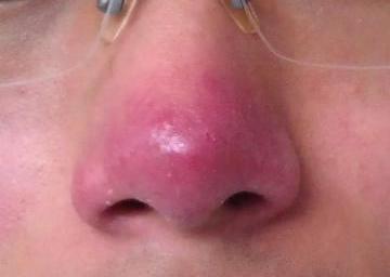 酒糟鼻症状损害会扩散到面部吗?