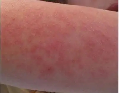 刺激性皮炎是不是过敏性皮炎吗?