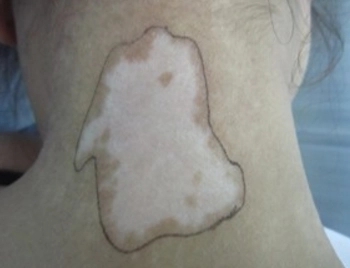 脖子上也会出现白癜风症状损害吗?