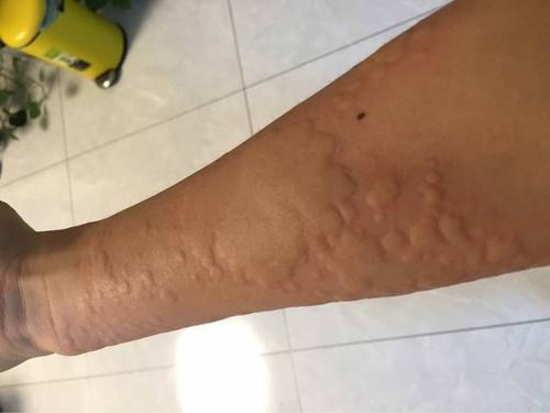荨麻疹患者是不是不能吹风呢?