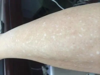 白癜风患者的体毛也会变白吗?